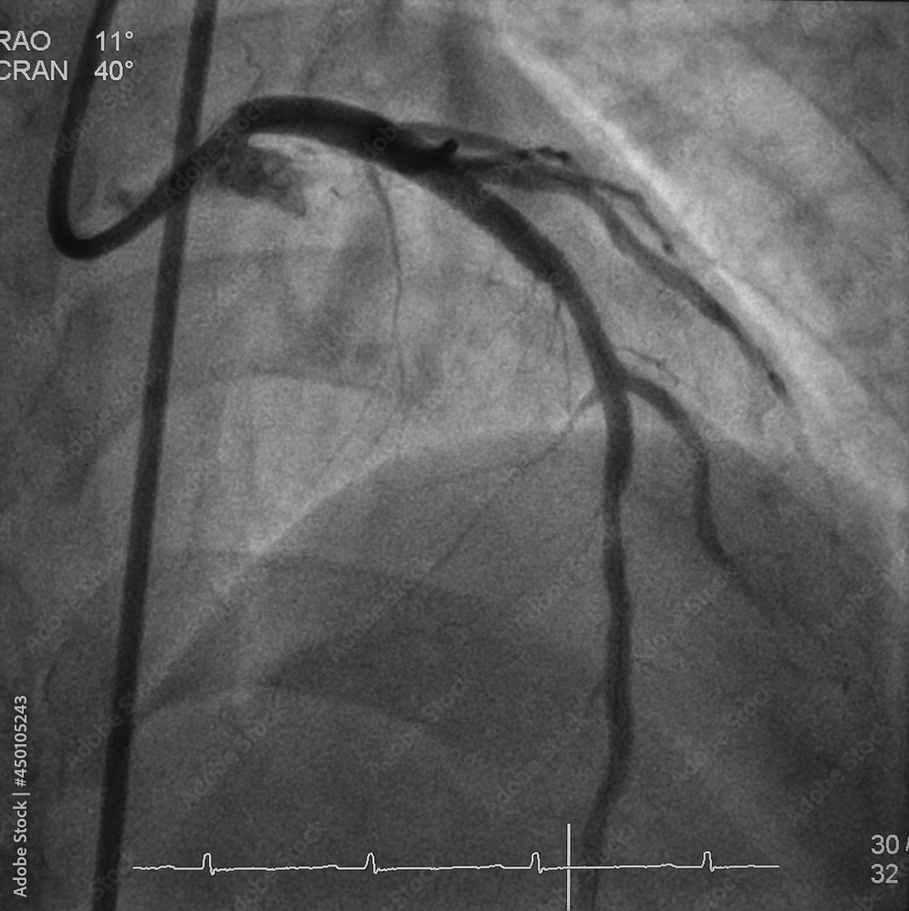 coronary angiogram (CAG) was showed left anterior descending artery