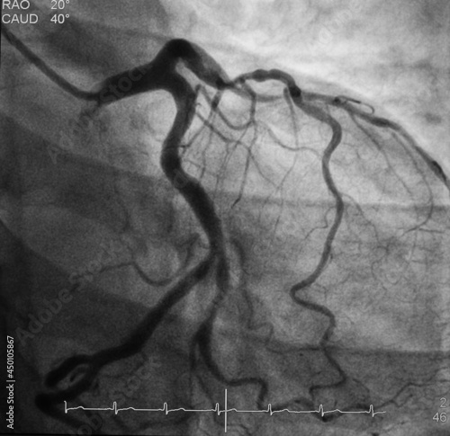 coronary angiogram (CAG) was showed left anterior descending artery (LAD) stenosis photo