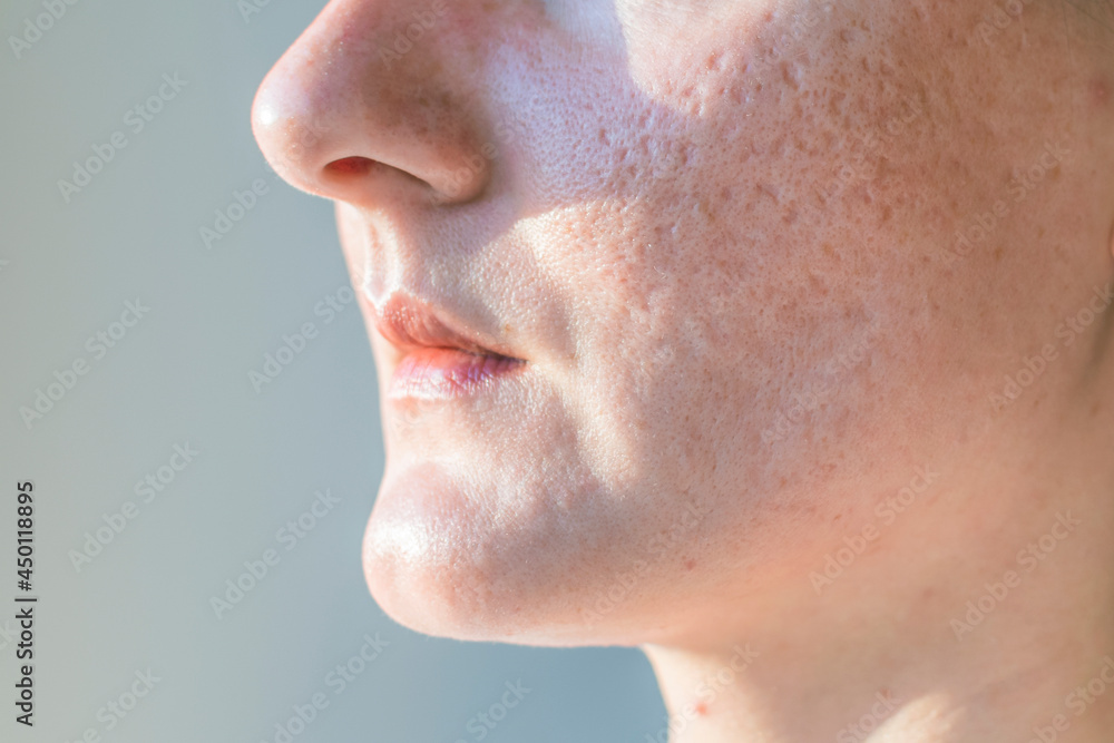 Acne scars on a woman is face close-up. Acne scars on a woman is face close-up.