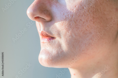 Acne scars on a woman is face close-up. photo