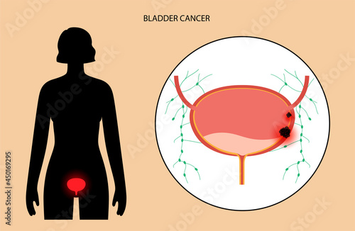 Bladder cancer stages
