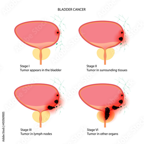 Bladder cancer stages