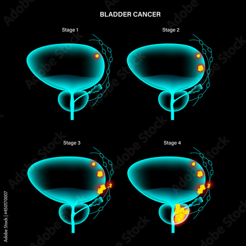 Bladder cancer stages