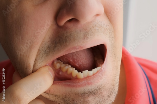 Man is showing tooth in mouth with a dental abscess fistula on gum, closeup view. Tooth with a temporary filling seal. Caries dental concept. Dental treatment of the internal parts of the tooth. photo