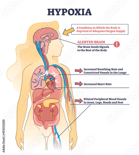 Hypoxia condition as lack of oxygen in brain cells or tissues outline diagram. Labeled medical description with disease symptoms and educational process scheme vector illustration. Hypoxemia disease.