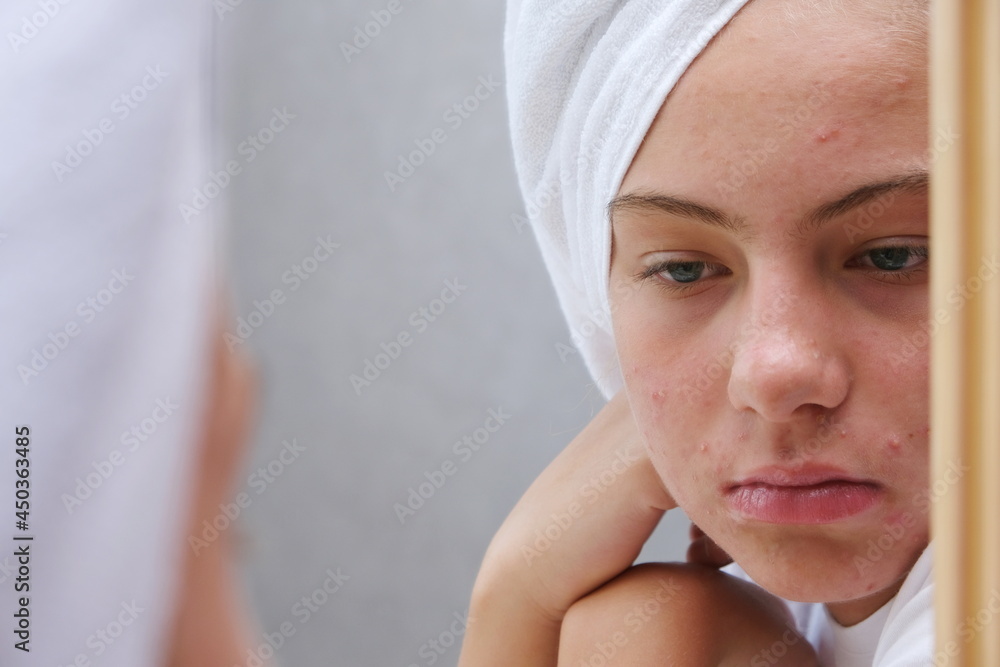 A sad teenage girl is looking at the pimples on her face in the mirror. Problematic skin in adolescents. A sad teenage girl is looking at the pimples on her face in the mirror. Problematic skin in adolescents.