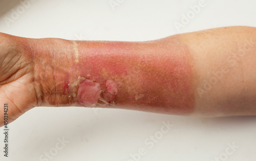 Close-up of a woman s hand with a burned skin of boiling water. Burn treatment theme. Red dead skin of the hands after a thermal burn. Selective focus