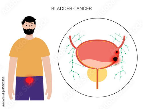 Bladder cancer stages