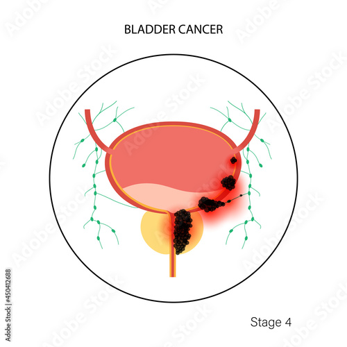 Bladder cancer stages