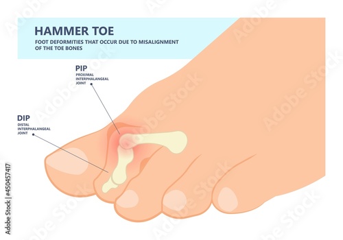 Hammer toe claw morton's hallux valgus curly turf bent joint flexible foot deformities shoes corns feet high heels curls bone spur distal lesser injury Trauma bend arch pes cavus flexion PIP DIP big