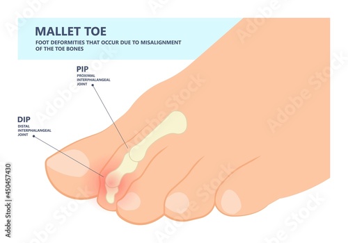 Hammer toe claw morton's hallux valgus curly turf bent joint flexible foot deformities shoes corns feet high heels curls bone spur distal lesser injury Trauma bend arch pes cavus flexion PIP DIP big