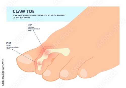 Hammer toe claw morton's hallux valgus curly turf bent joint flexible foot deformities shoes corns feet high heels curls bone spur distal lesser injury Trauma bend arch pes cavus flexion PIP DIP big