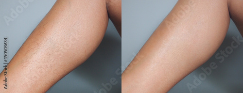 Image before and after leg hairs removal concept.