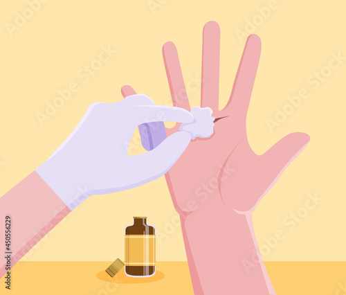 Doctors are treating the wound by wiping alcohol from a knife wound on the palm.
Illustration about wipe alcohol.