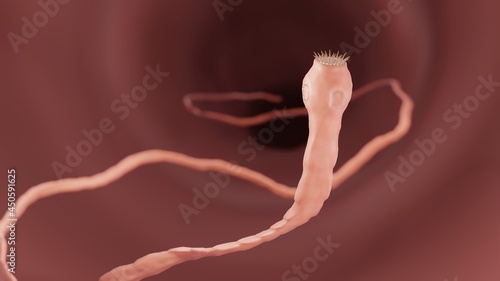 Tapeworm in the intestine, Parasitic infection illustration