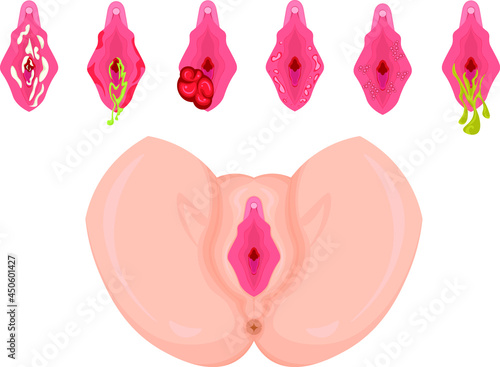 女性外性器　病気