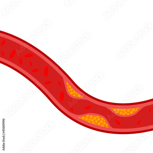 artery blocked with cholesterol