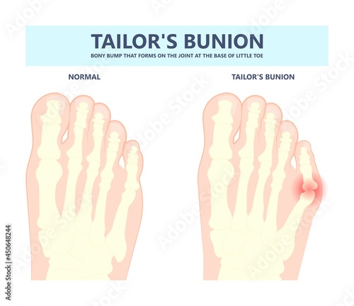 bony bump joint big toe bone enlarge fifth foot pain shoe Tailor swollen feet wearing poor fitting high heel Inversion lump bursa Hammer bend tendon stress injury gout spur callus corn turf flat feet