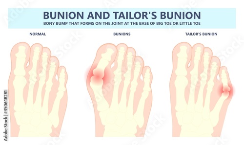 bony bump joint big toe bone enlarge fifth foot pain shoe Tailor swollen feet wearing poor fitting high heel Inversion lump bursa Hammer bend tendon stress injury gout spur callus corn turf flat feet