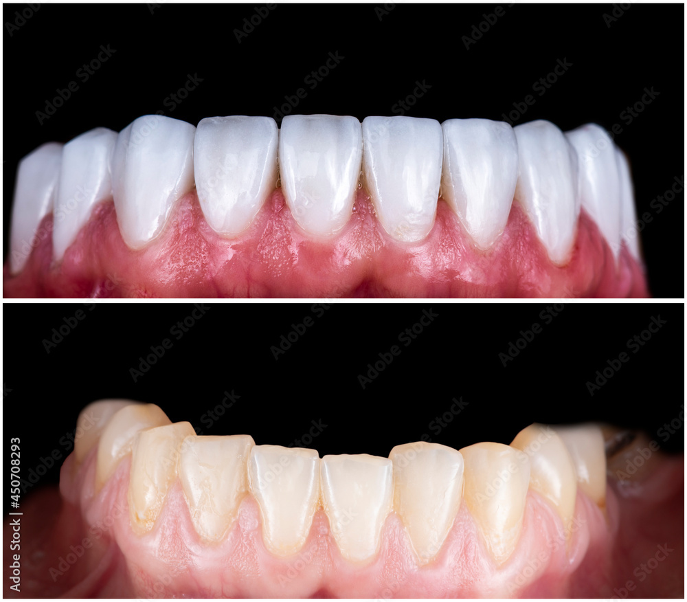 Obraz premium press ceramic crowns and veneers bl2