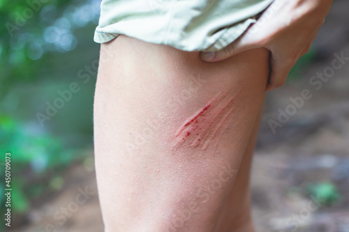 Wound during hiking, sport bruise injury scratch on a leg during outdoor forest trekking, close-up view of girl's woman leg with a big red trauma abrasion