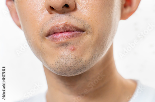 ニキビに悩む男性の写真。肌トラブルのイメージ。