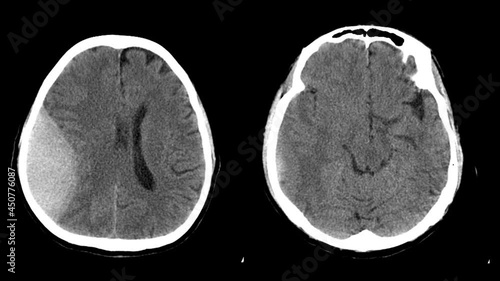 CT picture of the human brain.
