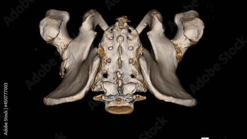 CT Pelvis Bone 3D rendering image isolated on a black background showing: Myositis ossification at muscle superolateral to the right acetabulum.
