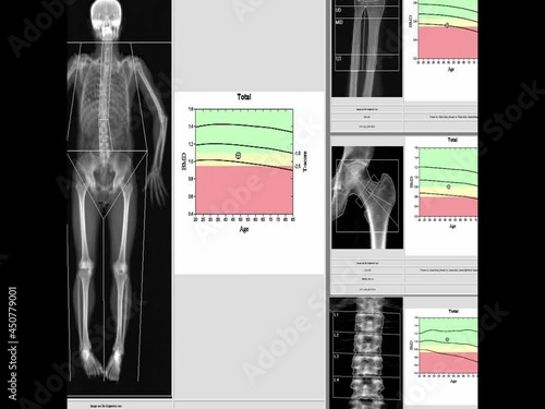 Special examination of bone density. Result Osteoporosis too blurriness and artifacting image when viewed at full resolution,
