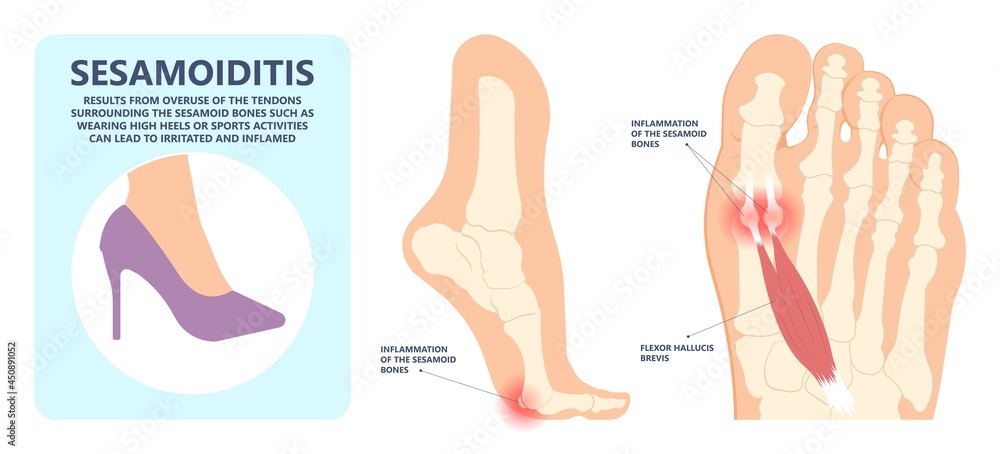 Calcaneus Fractures: Common Causes, Treatment, Recovery