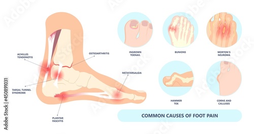 bone tendon joint inflamed foot big toe sport injury pain under ball bend hurt trauma wearing high heel shoes arched feet Turf gout stress morton flat spur corns tear plate Broken tunnel tarsal ankle photo