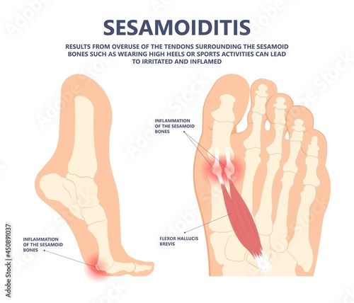 bone tendon joint inflamed foot big toe sport injury pain under ball bend hurt trauma wearing high heel shoes arched feet Turf gout stress morton flat spur corns tear plate Broken tunnel tarsal ankle