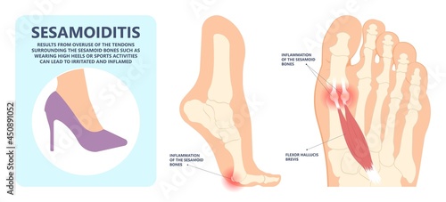 bone tendon joint inflamed foot big toe sport injury pain under ball bend hurt trauma wearing high heel shoes arched feet Turf gout stress morton flat spur corns tear plate Broken tunnel tarsal ankle