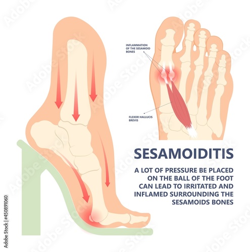 bone tendon joint inflamed foot big toe sport injury pain under ball bend hurt trauma wearing high heel shoes arched feet Turf gout stress morton flat spur corns tear plate Broken tunnel tarsal ankle