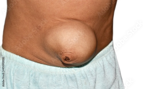 Umbilical hernia of Asian child. photo