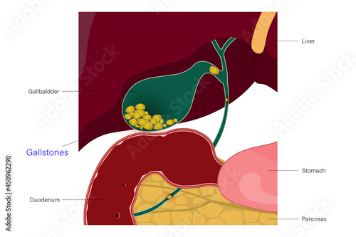 Gallstones in the gallbladder. Blockage of gallstones in cystic duct and common bile duct. Digestive organs. Liver. Stomach. Pancreas.