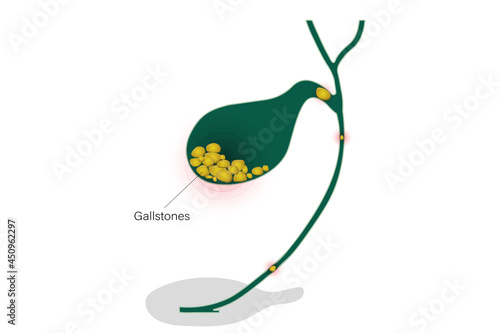 Gallstones in the gallbladder. Blockage of gallstones in cystic duct and common bile duct. photo