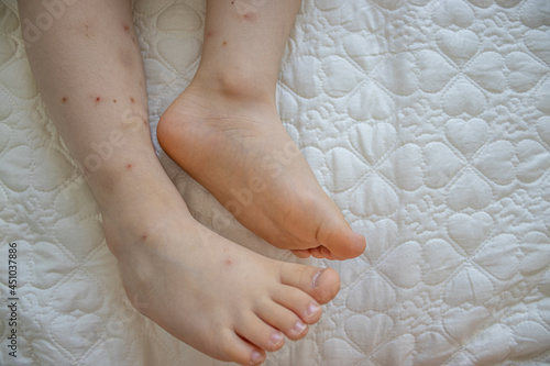 Child s legs with a lot of hair  bruises  with many red spot  wounds from scratches and scars from insect bite  mosquitos and fleas. Kid s legs are on a bed coverlet and the nails are uncut.