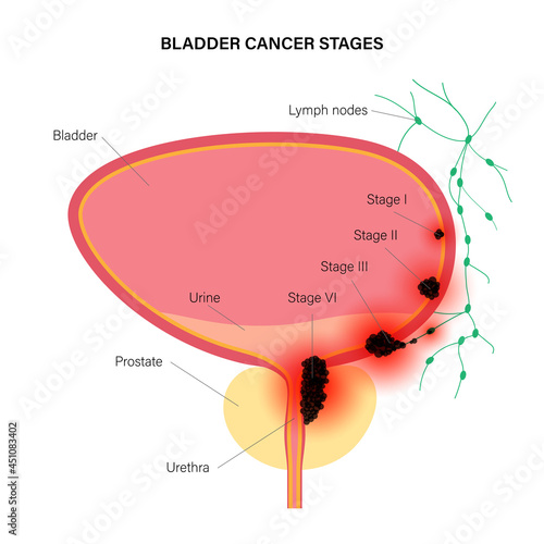 Bladder cancer stages
