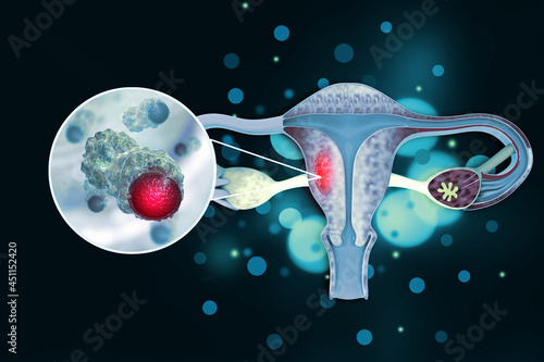 Female reproductive system diseases. Uterus cancer and endometrial malignant tumor as a uterine medical concept. 3d illustration