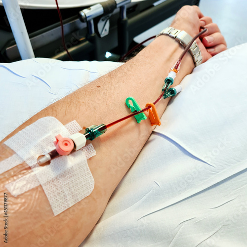 Cannula in arm in preparation for intravenous iron infusion