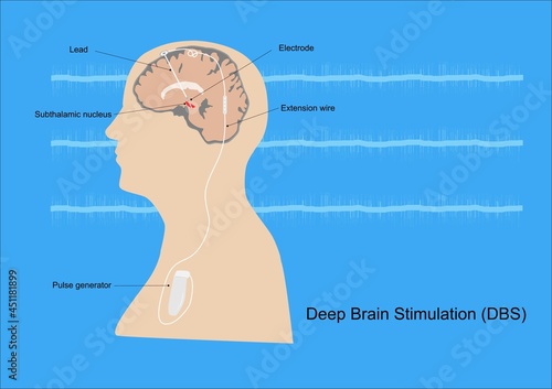 Neuromodulation with deep brain stimulation or DBS at subthalamic nucleus for treatment of Parkinson's disease. Illustration of medical equipment and neural signal.