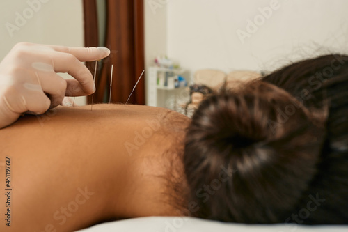 Reflexology. Treatment of back pain and tightness with acupuncture needles for a female patient
