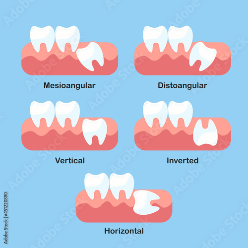 Wisdom tooth impaction problems icon set