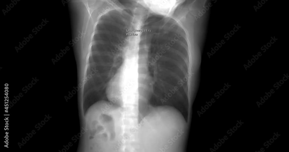 Chest x-ray 3D rendering from data of CT Chest scan. Chest x-ray 3D rendering from data of CT Chest scan.