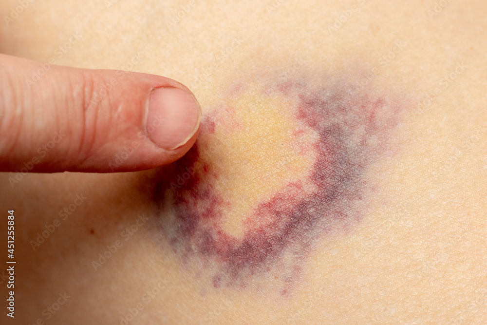 Fototapeta premium The man points a finger at the hematoma. Hematoma on the leg