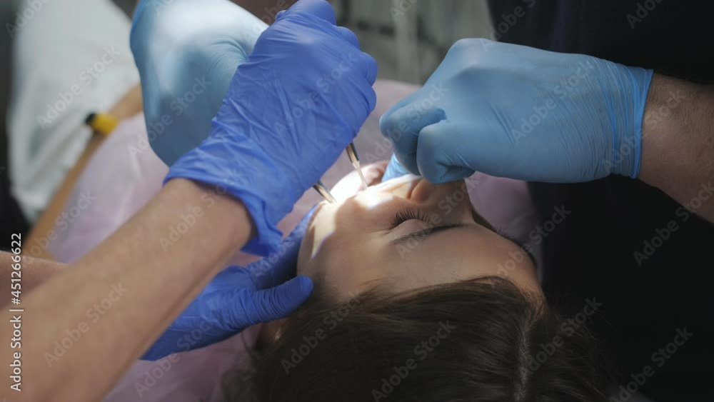 The process of suturing a wound by a dentist after removing a wisdom tooth from a patient. The process of suturing a wound by a dentist after removing a wisdom tooth from a patient.