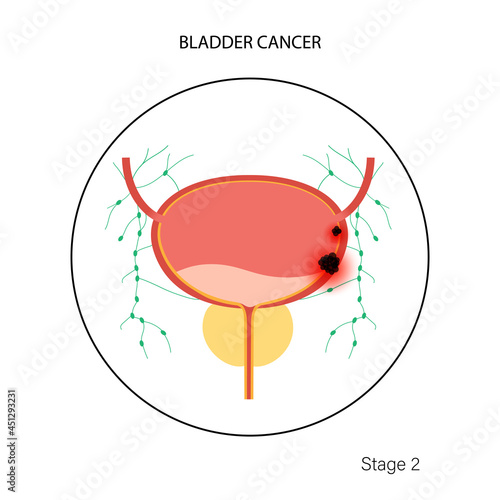 Bladder cancer stages