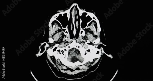 CT brain scan of a brain of a patient with acute lacuna infarction in the left caudate nucleus and chronic cerebral infarction of the right frontal lobe. photo