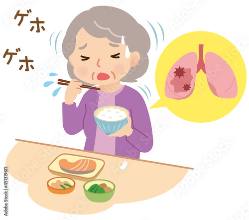 誤嚥 食事中にむせる高齢者